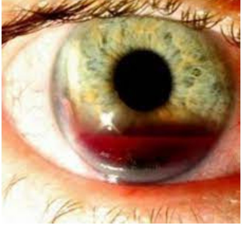 Eye photograph after squash-ball injury