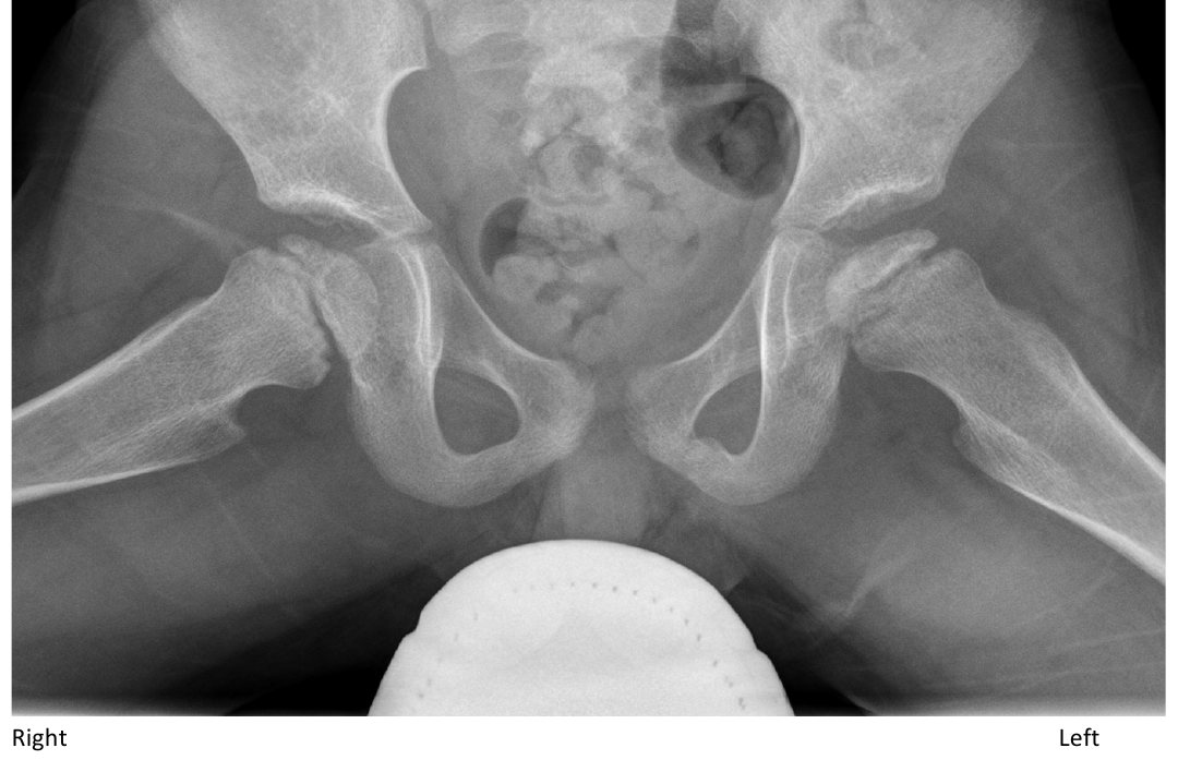 Pelvic X-ray for a young child with atraumatic limp