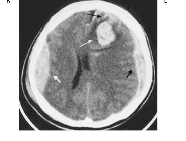 CT brain image after assault with head injury