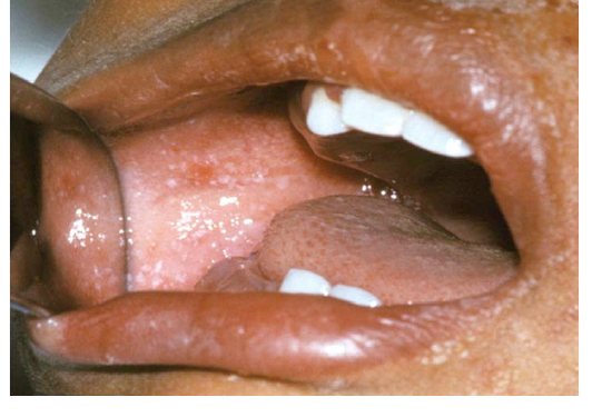 Clinical photograph for febrile child with rash