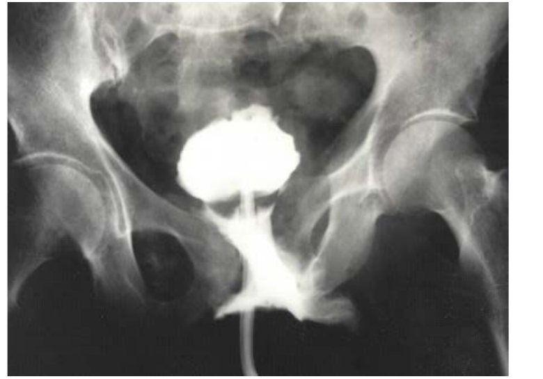 Pelvic contrast X-ray after motorbike crash
