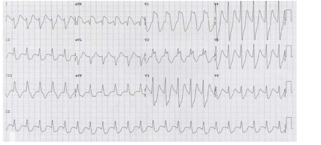 ECG for drowsy patient before intubation