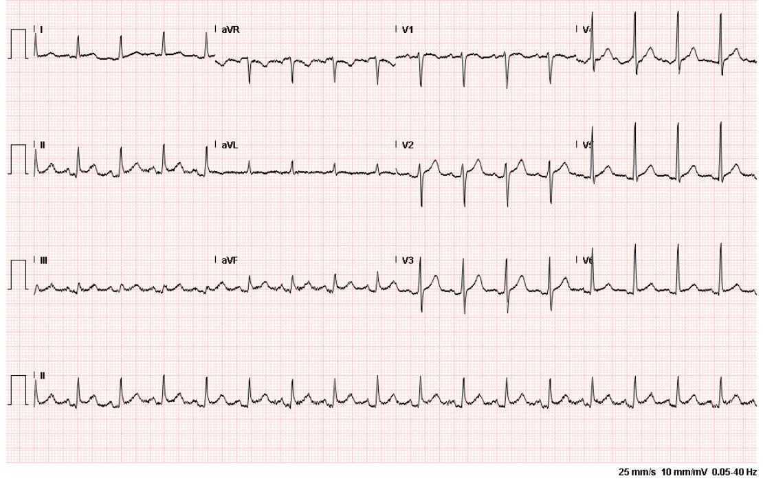 ECG for dialysis patient with chest pain