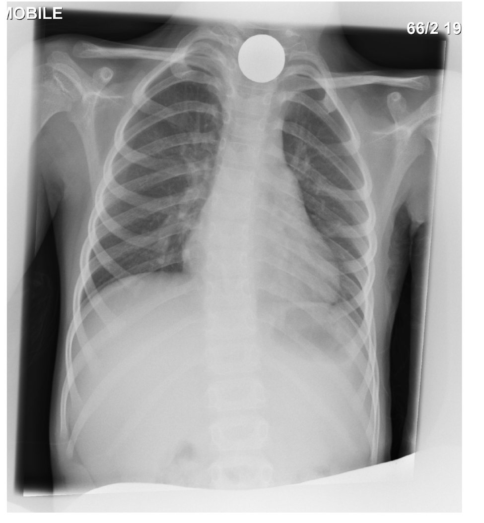 Chest and neck X-ray after a child swallowed an earring