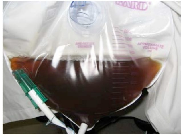 Catheter bag with dark urine in a collapsed young adult