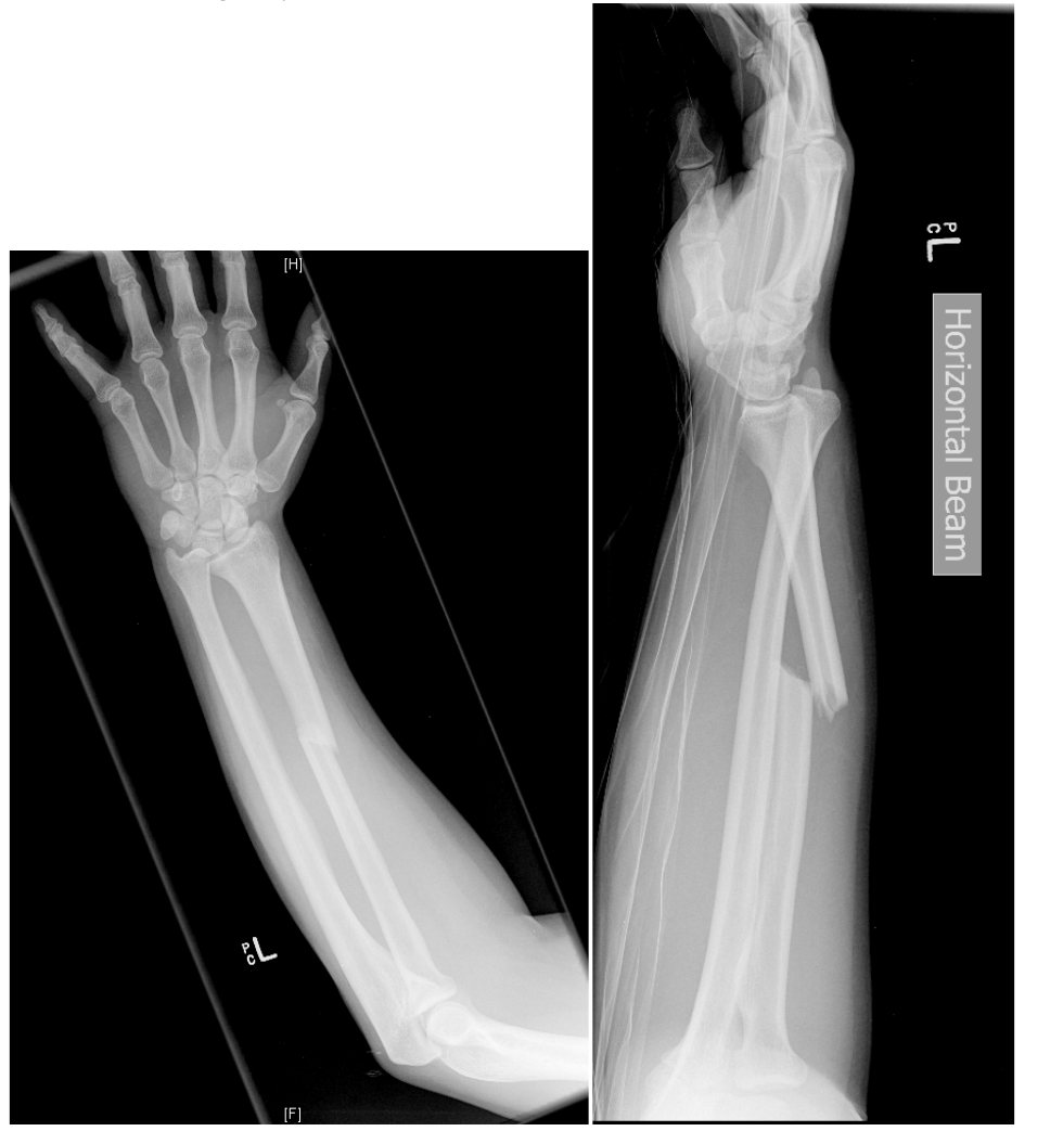 Left forearm X-rays after bicycle fall