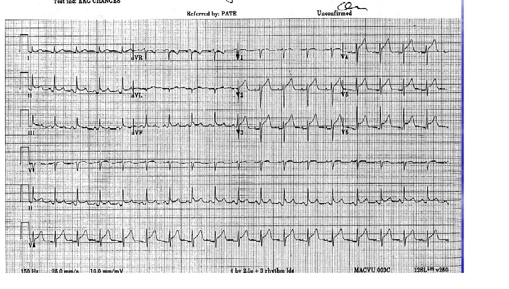 ECG from the source question in a patient with chest pain