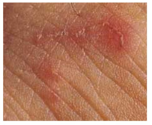 Clinical photograph from the source question showing a palm rash