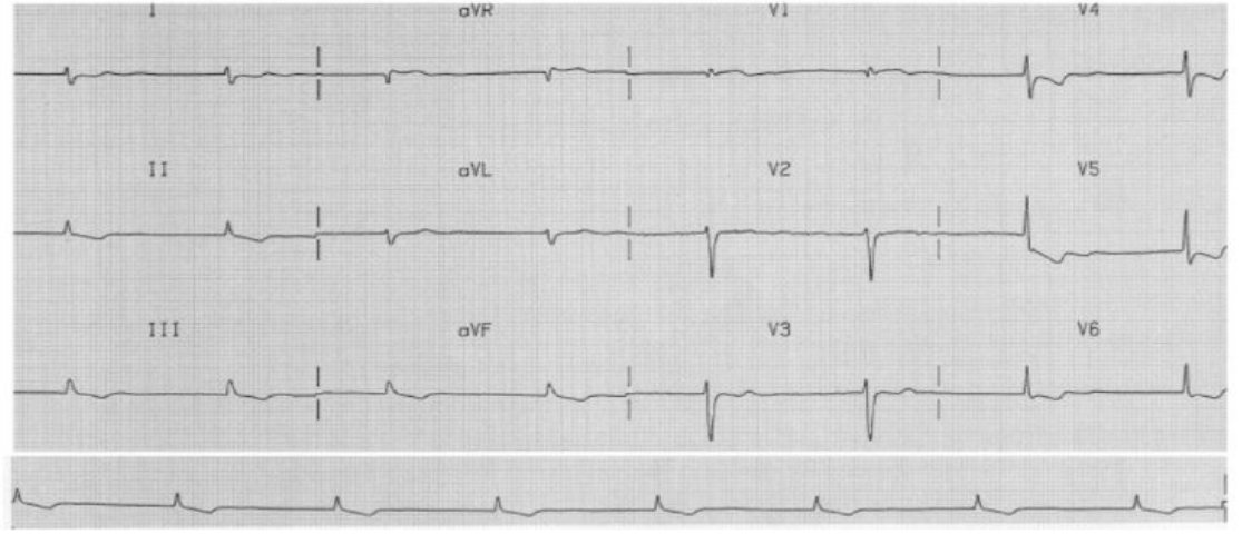 ECG from the source question in a patient with bradycardia