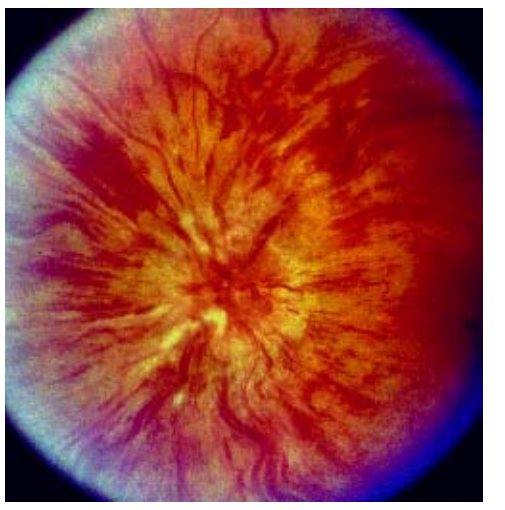 Fundus photograph from the source question