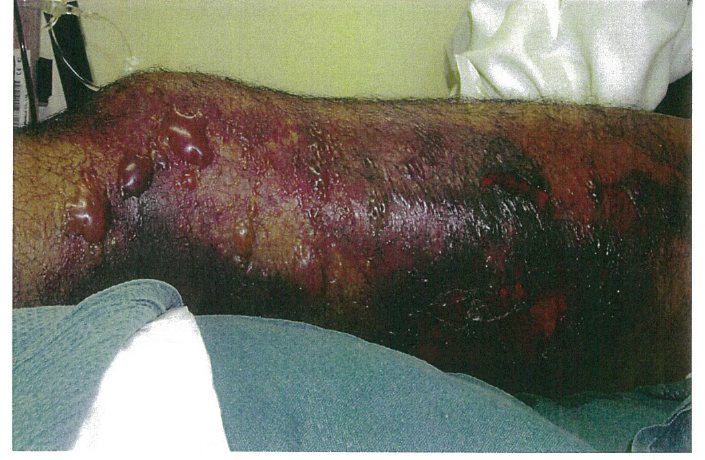Clinical photograph from the source question showing the left thigh