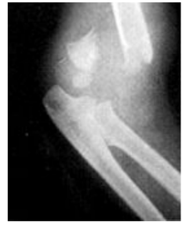 Lateral elbow X-ray from the source question