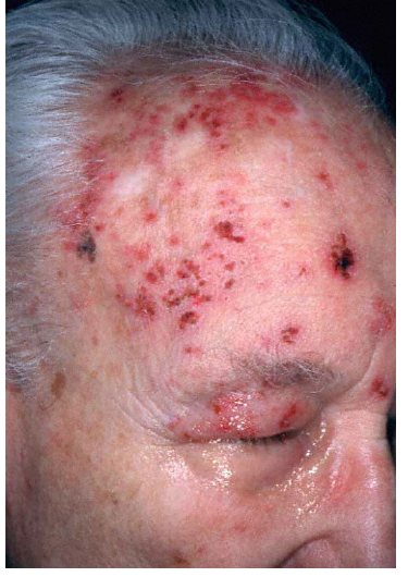Clinical photograph from the source question showing a facial rash