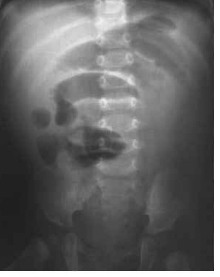 Abdominal X-ray from the source question in an unwell toddler