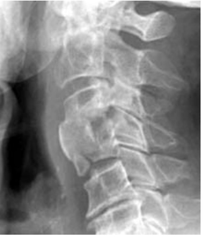 Lateral cervical spine X-ray from the source question