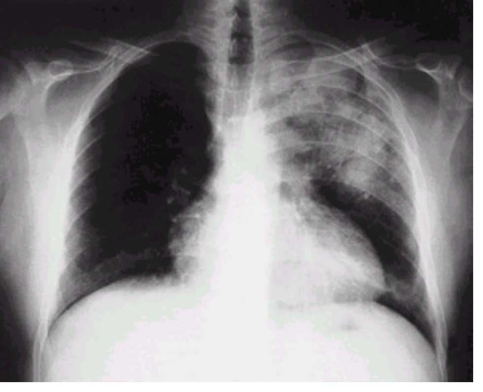 Chest X-ray from the source question