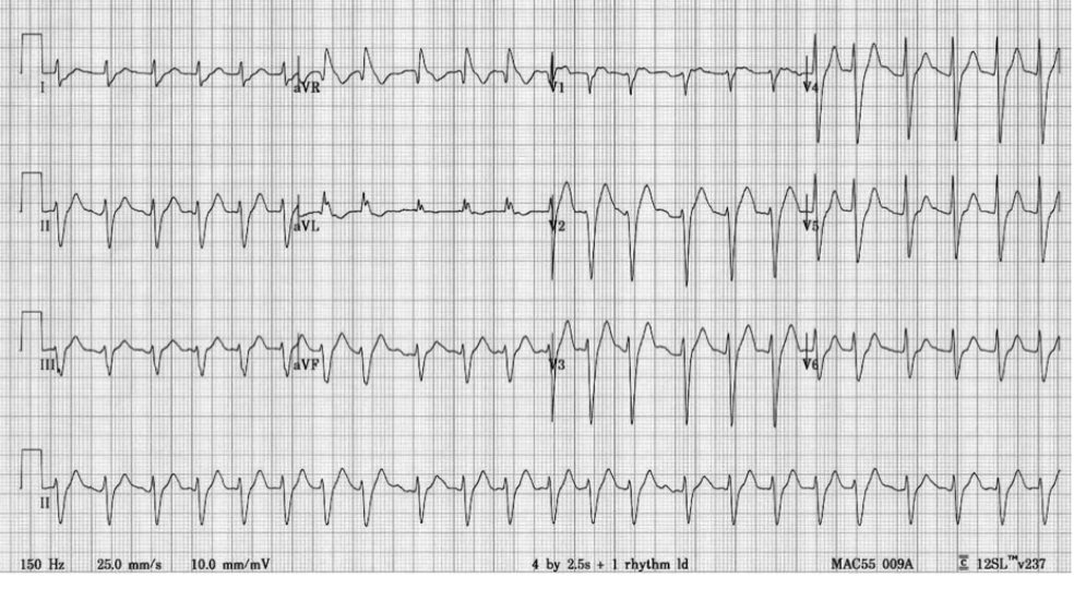 ECG from the source question after an overdose