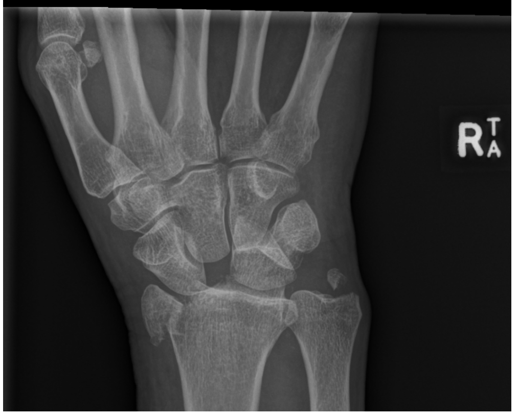 Right wrist x-ray AP view