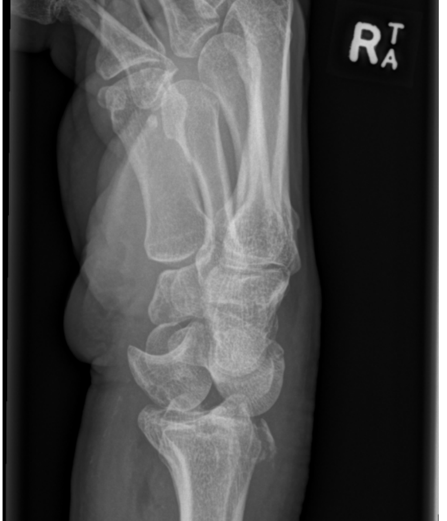 Right wrist x-ray lateral view
