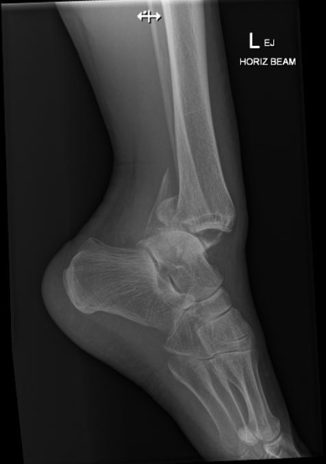 Ankle x-ray AP view