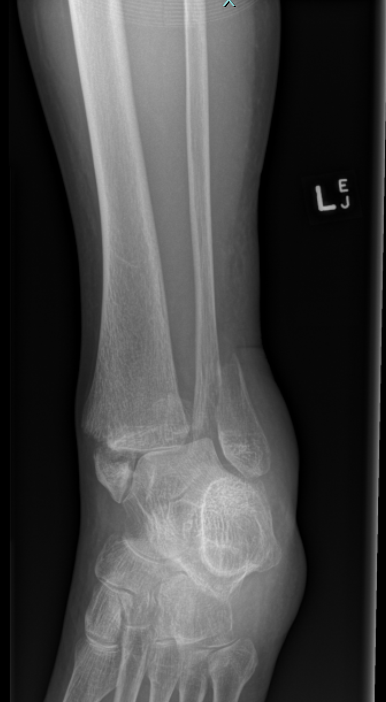 Ankle x-ray mortise view