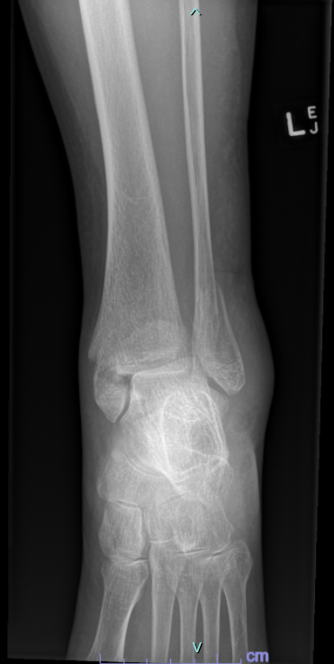 Ankle x-ray lateral view