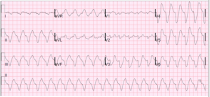 12-lead ECG with wide complex tachycardia