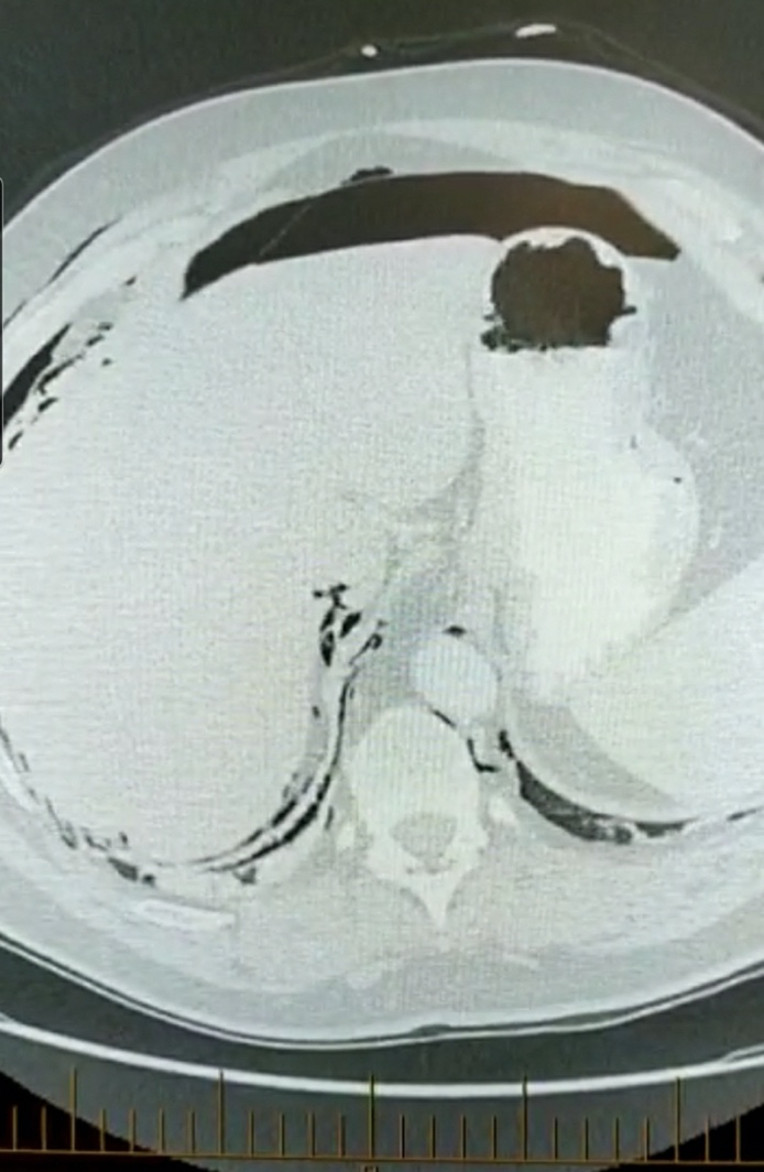 CT chest and abdomen image 2