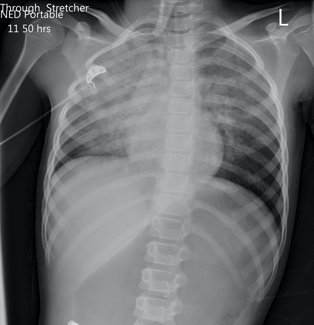 Chest x-ray after choking episode