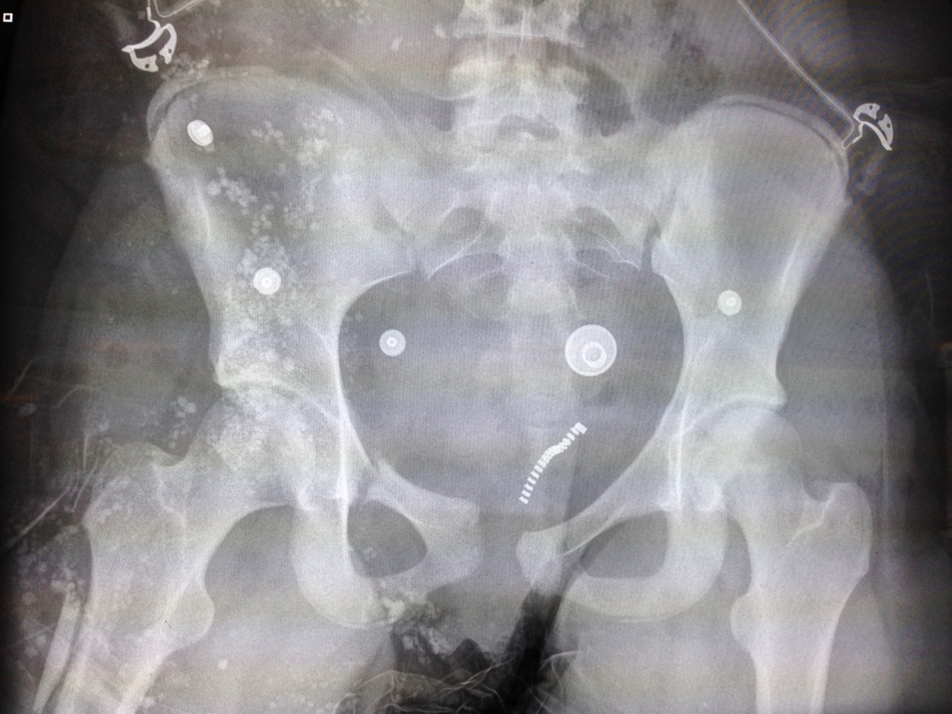 Pelvic x-ray from the source question