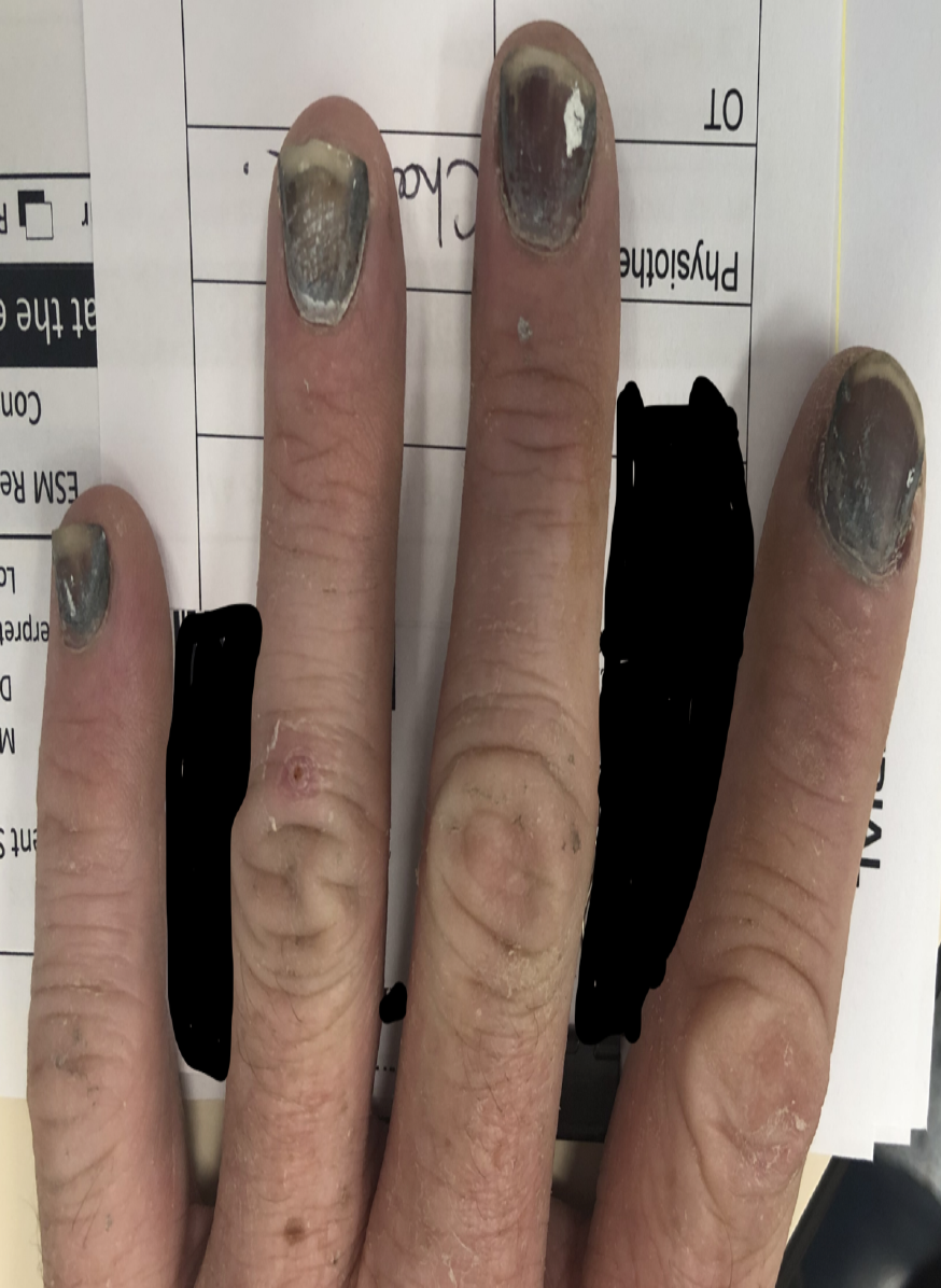 Clinical photograph of the left hand from the source question