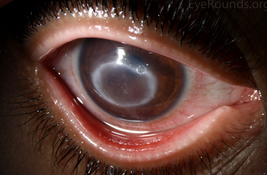 Clinical photograph of the affected eye from the source question