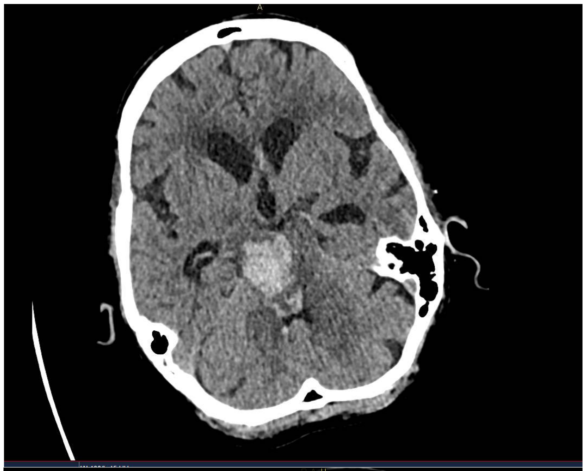 Non-contrast CT brain slice from the source question