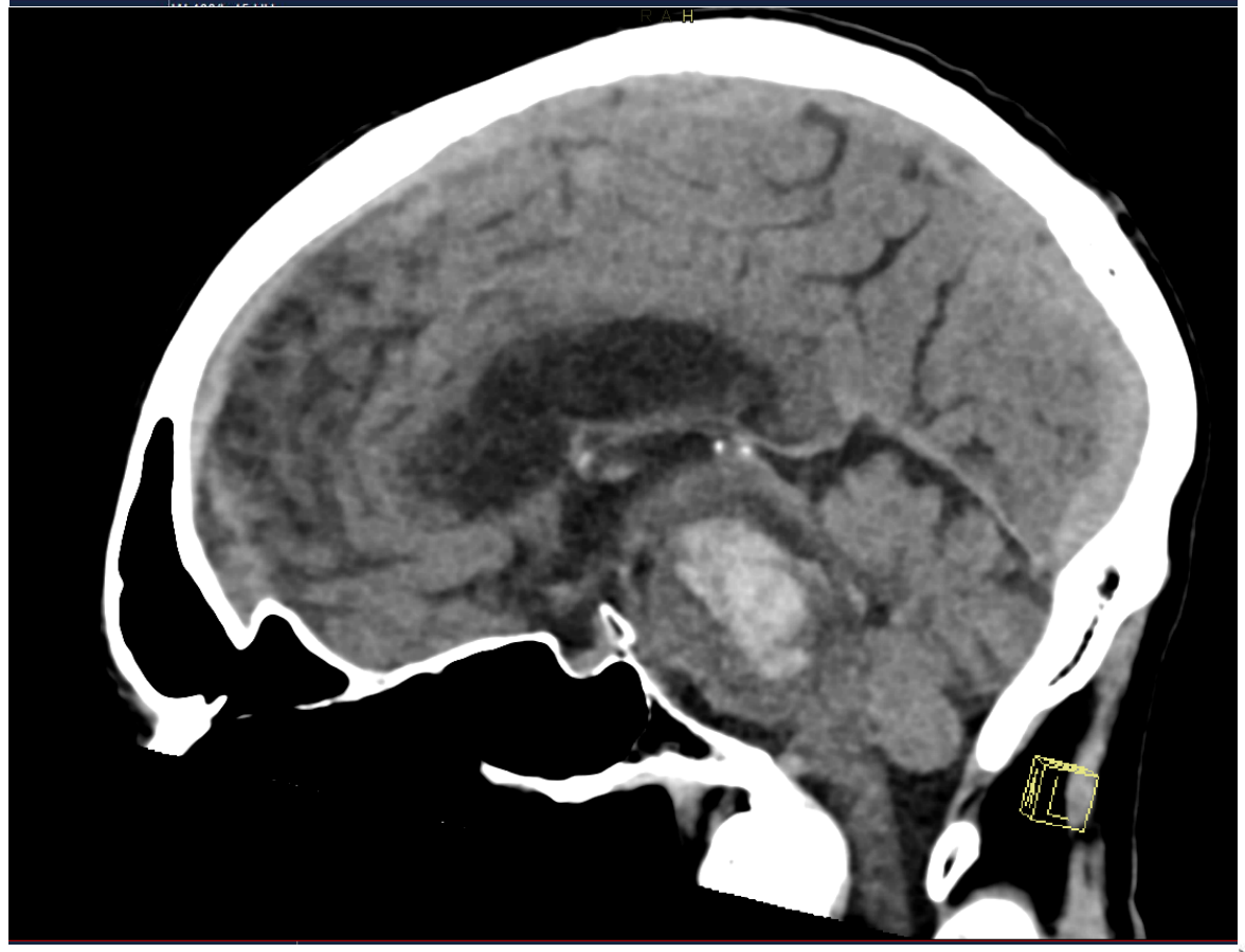Non-contrast CT brain slice from the source question