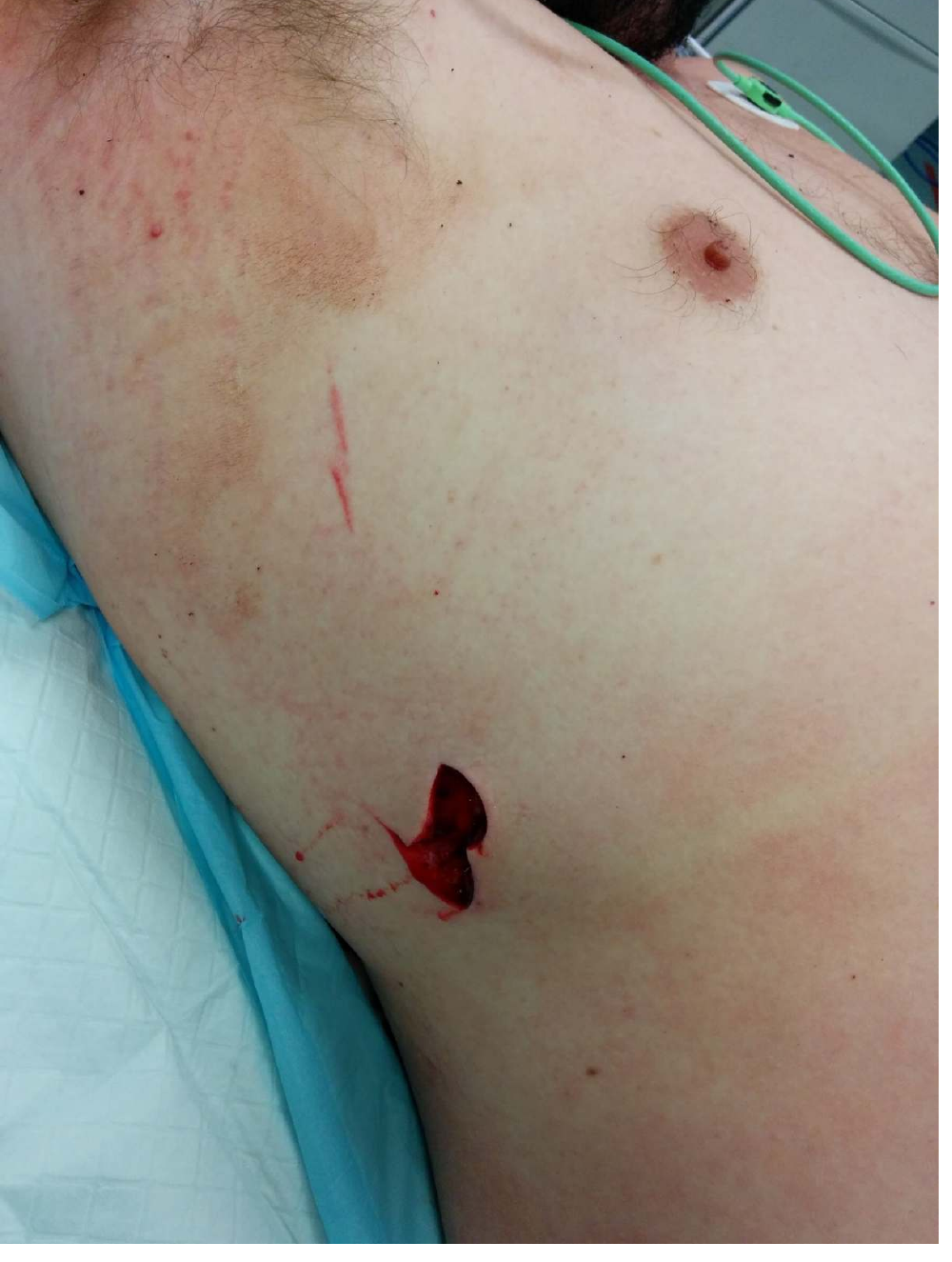 Chest wound photograph from the source question