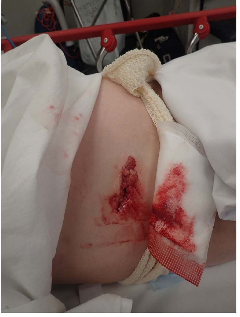 Clinical photograph of a right lateral abdominal laceration from penetrating trauma in a child.