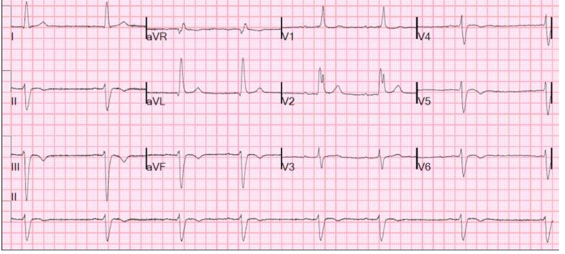 ECG for a patient after syncope.
