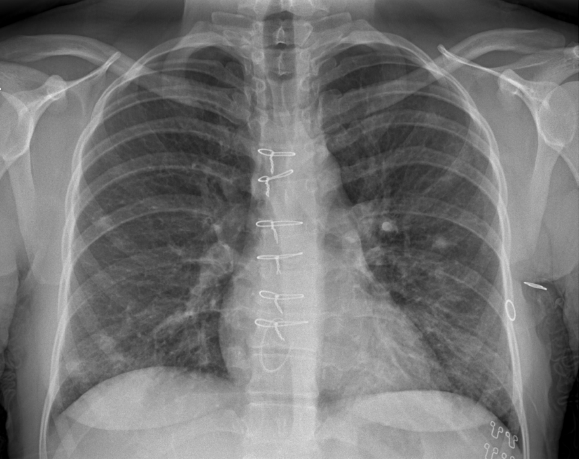 Chest x-ray for a febrile patient.