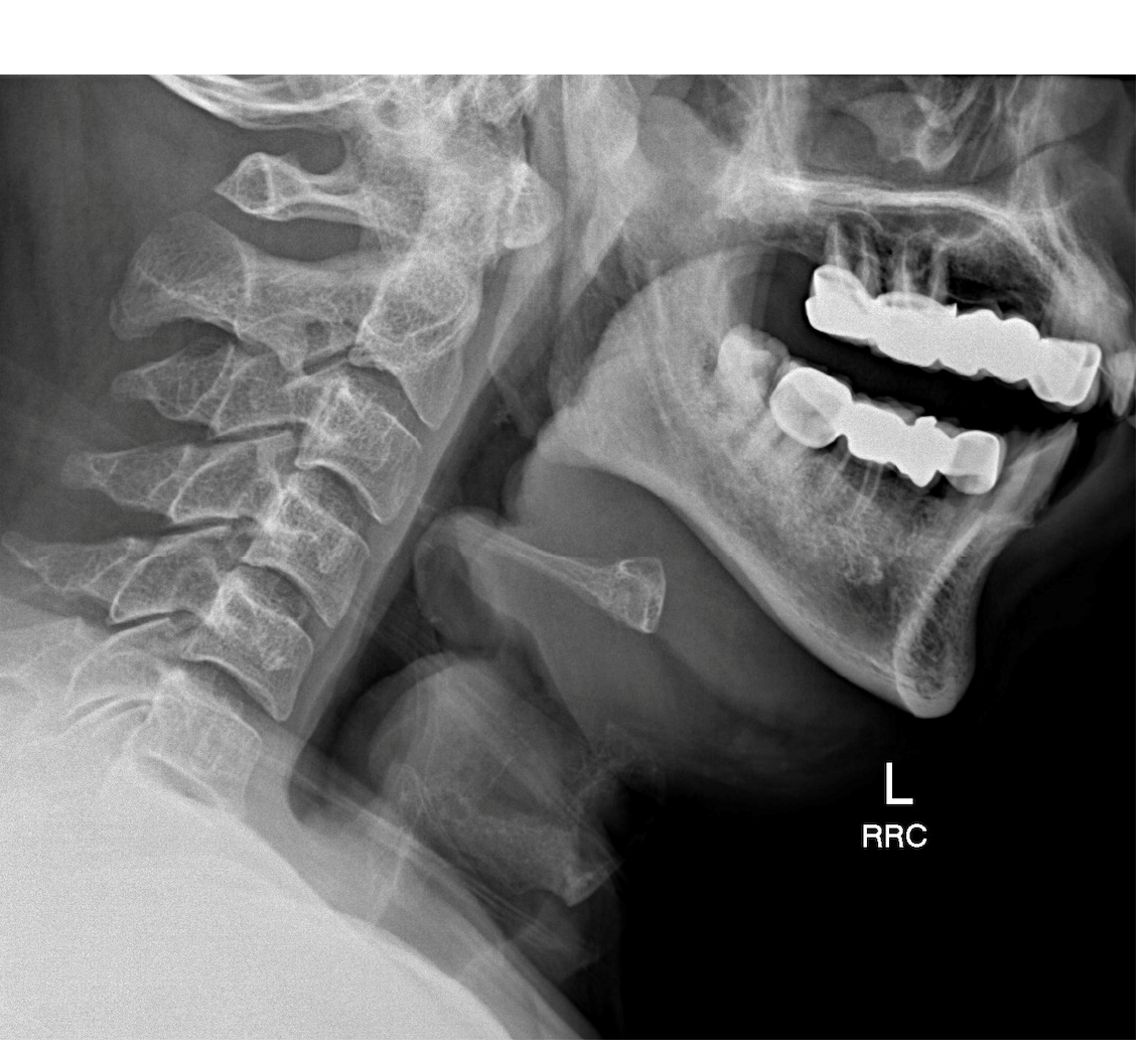 Lateral neck x-ray for a patient with dysphagia and stridor.