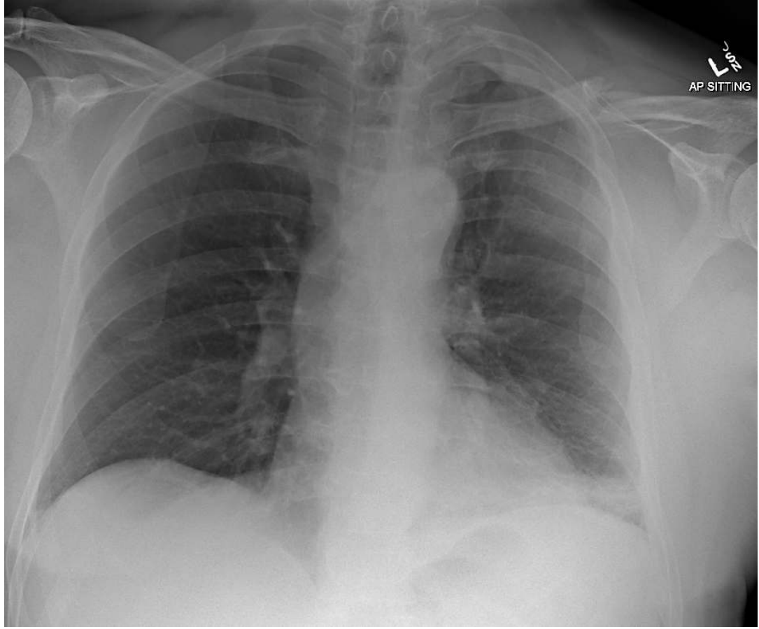 Chest x-ray for a patient after a dirt bike fall.