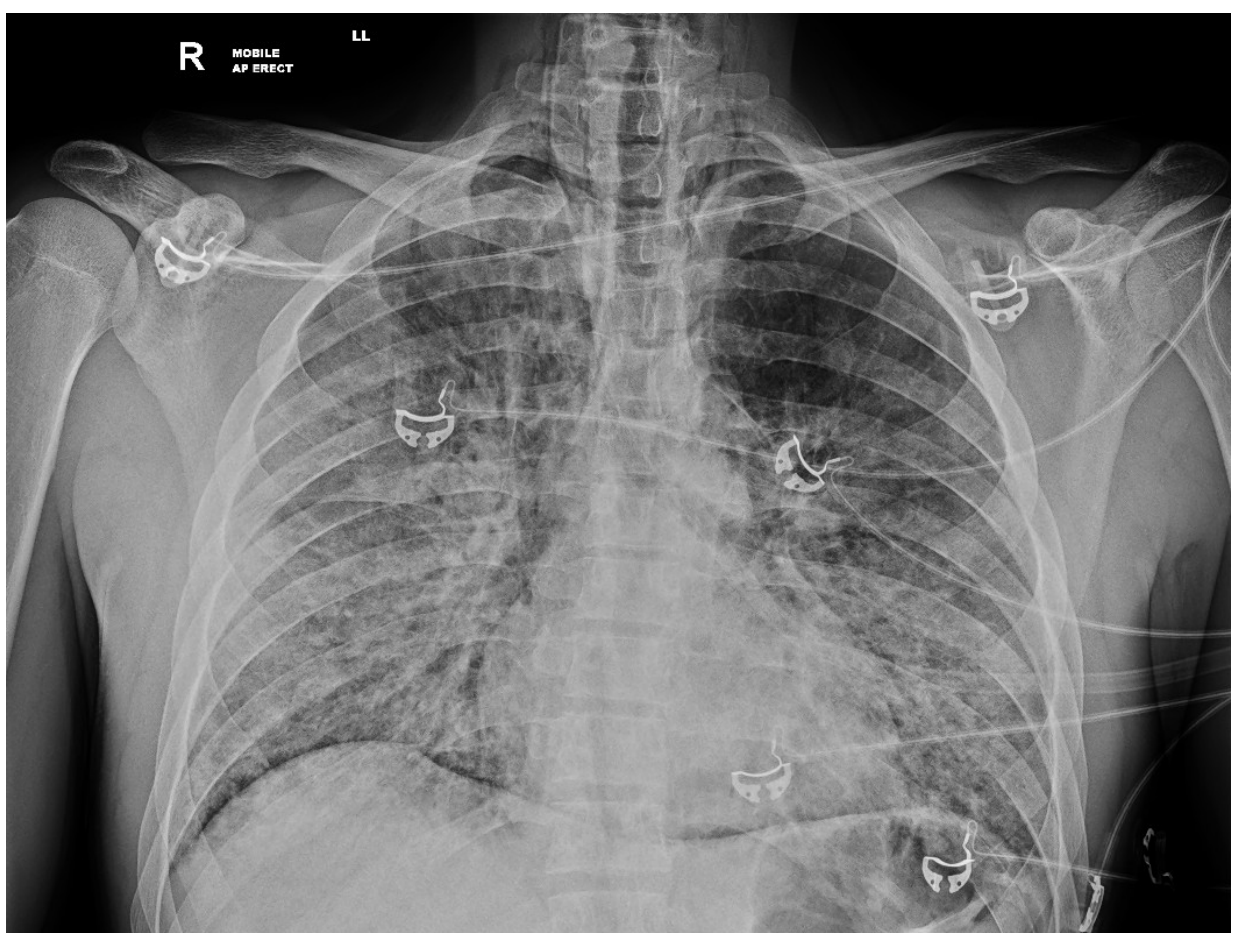 Chest x-ray from the source question