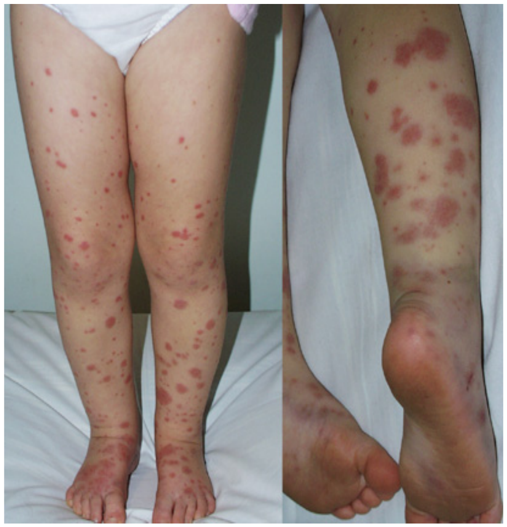 Lower limb rash photograph from the source question