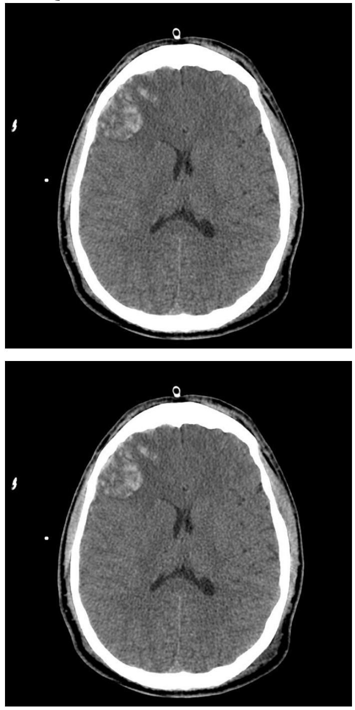 Two axial non-contrast CT brain slices in a child with haemophilia and head injury.